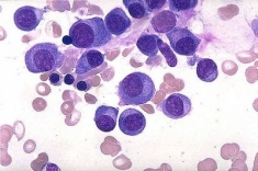 A Reggio Calabria congresso sul mieloma multiplo